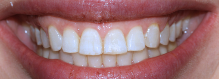 Showing the smile after Invisalign at Dental Care Stamford