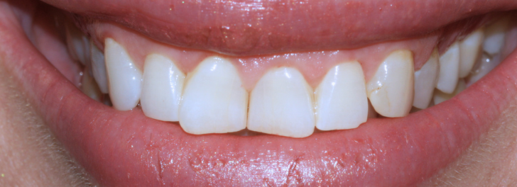 Showing the smile before Invisalign at Dental Care Stamford