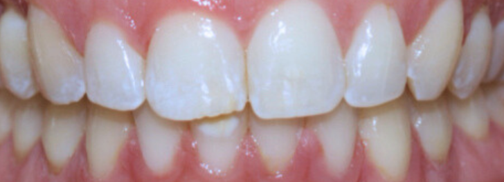 Showing the smile after Invisalign at Dental Care Stamford