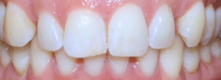 Showing the smile before Invisalign at Dental Care Stamford