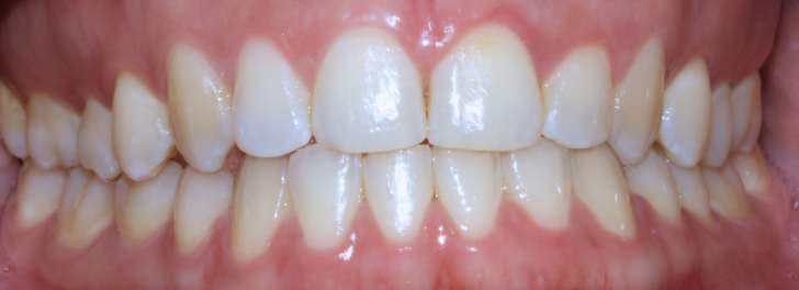 Showing the smile after Invisalign at Dental Care Stamford