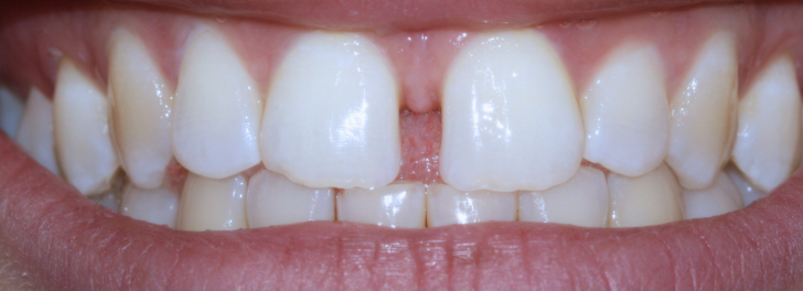 Showing the smile before Invisalign at Dental Care Stamford